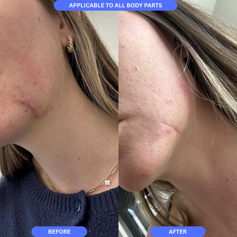 Silicone Scar Sheets