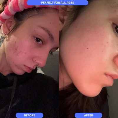 Silicone Scar Sheets